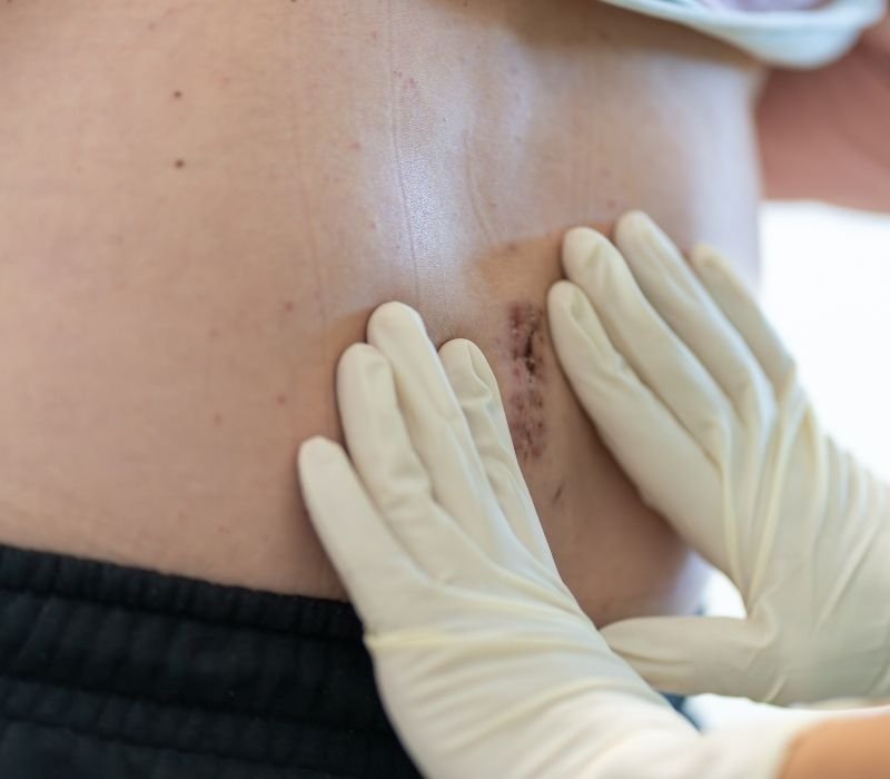 Reparación laparoscópica de hernias